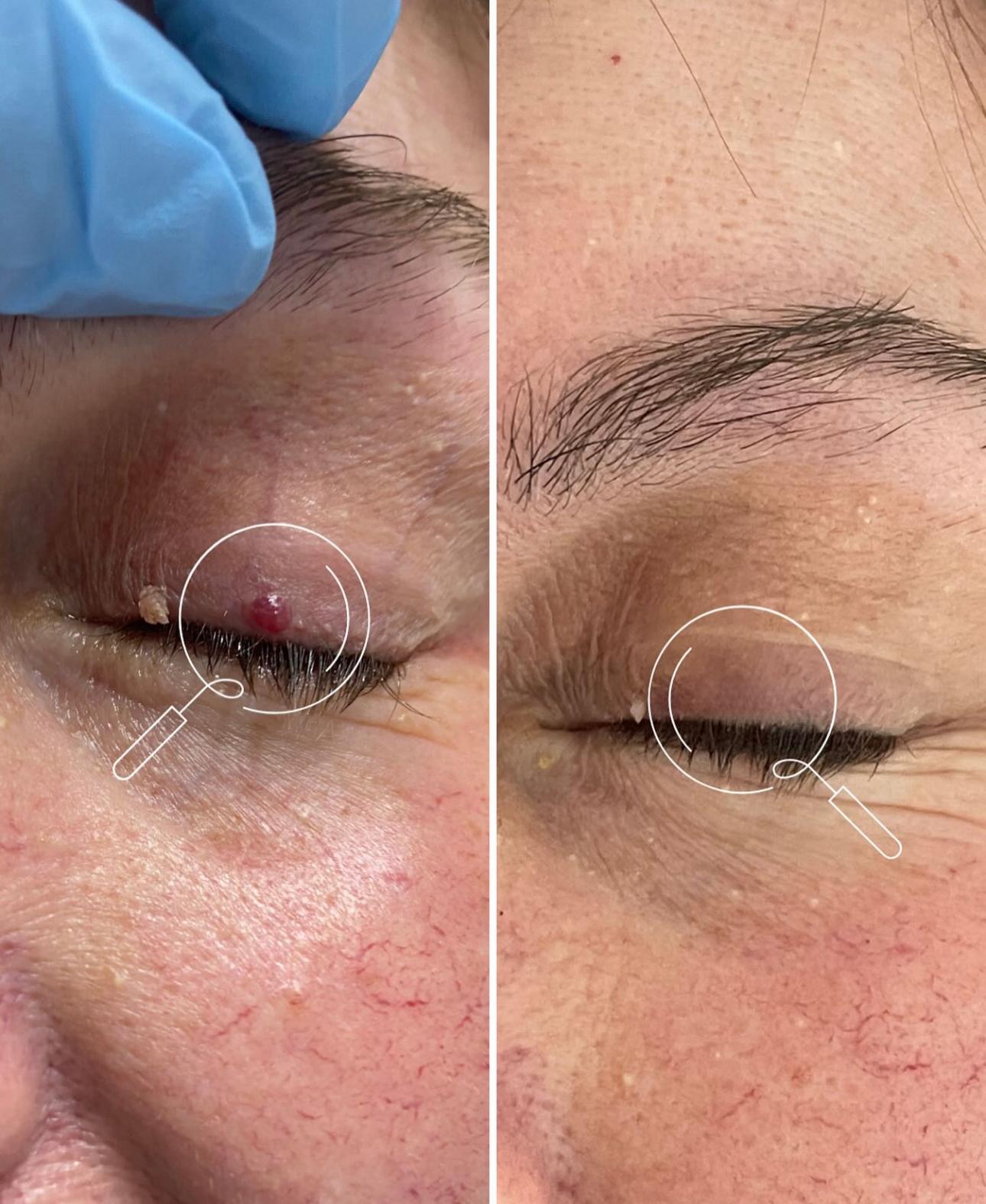 The image depicts a close-up of a man's left eye, showing a red bump near the eyelid. The left side of the image shows a z...